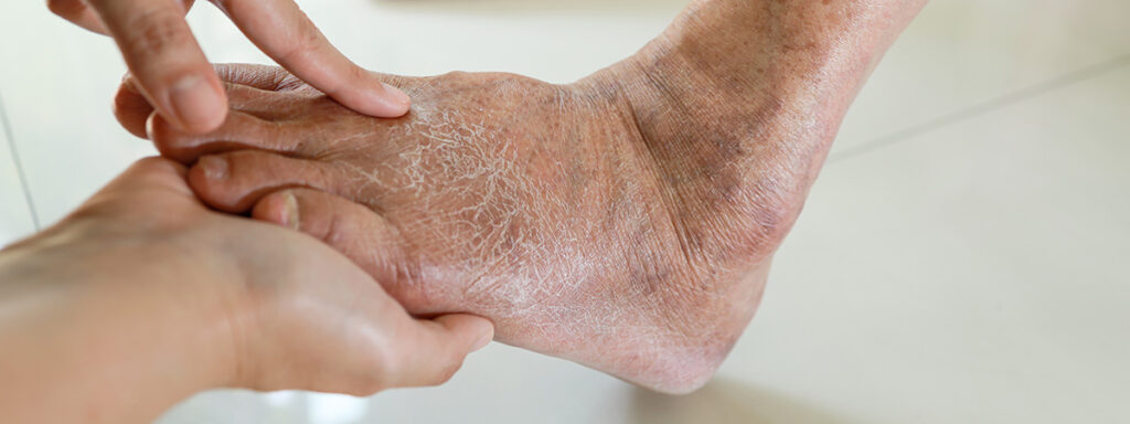 Hands of doctor or nurse examining the dry,cracked,swollen feet
